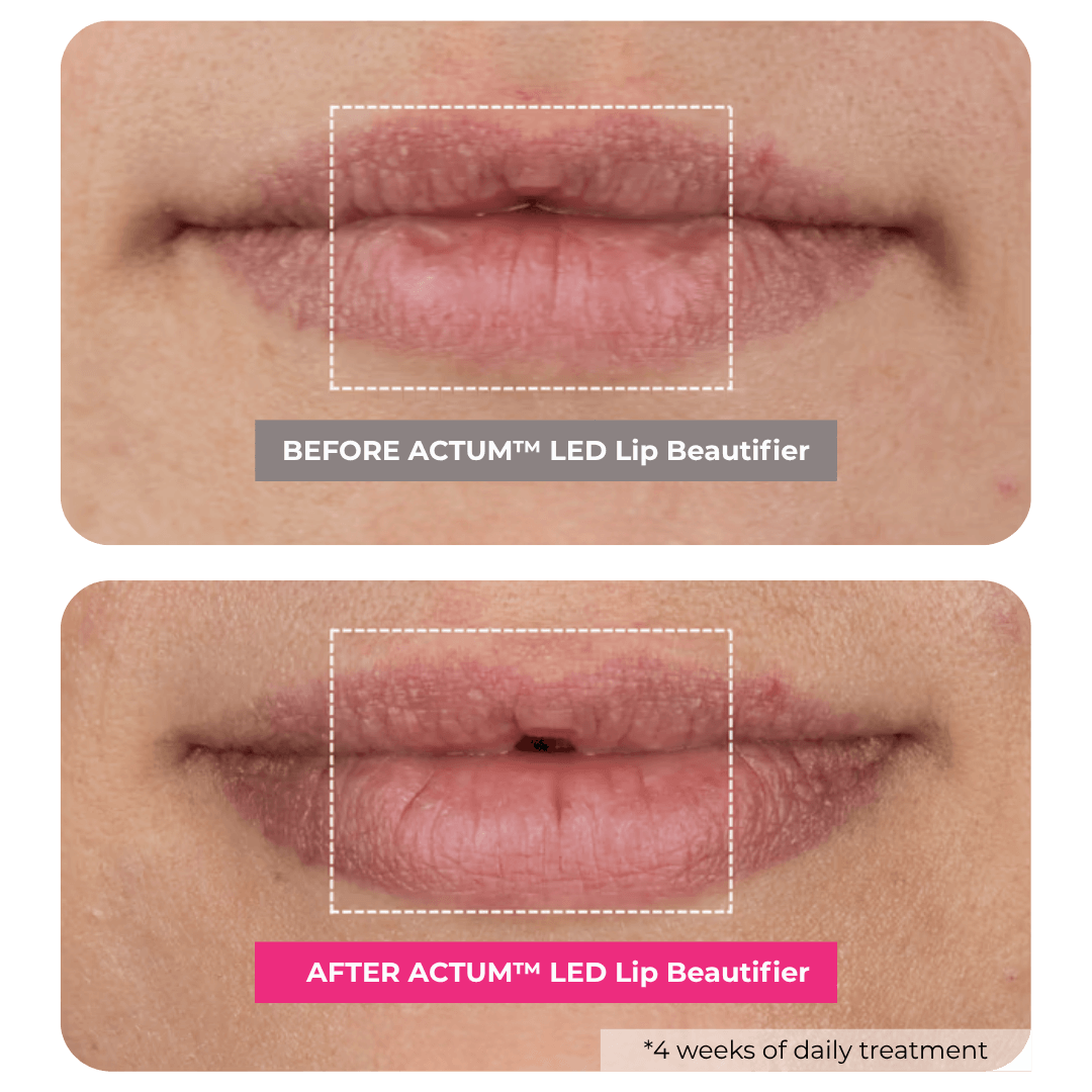 ACTUM™ LED Lip Beautifier
