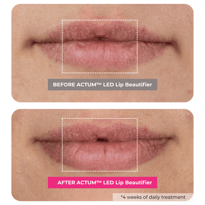 ACTUM™ LED Lip Beautifier